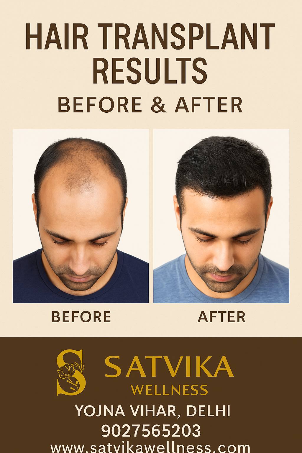Hair Transplant in East Delhi – Regain Confidence with Natural Hair at Satvika Wellness Clinic